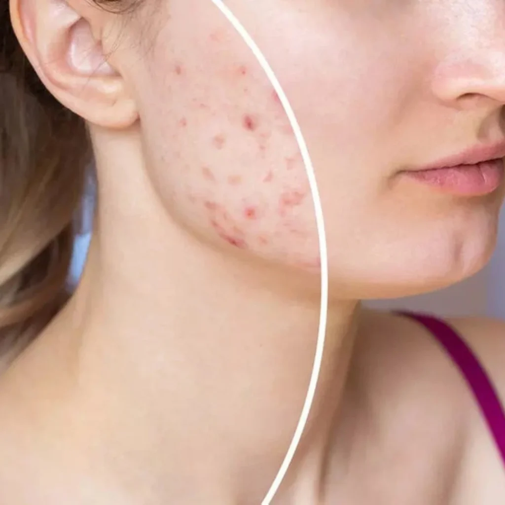 Fix acne & blemishes instantly